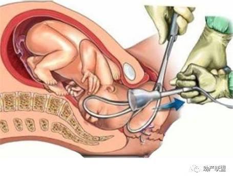 五种分娩术助产妇安全分娩
