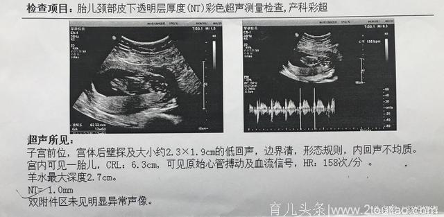 孕期6次彩超全分享：双顶径、股骨长、胎心率，是否有规律可循