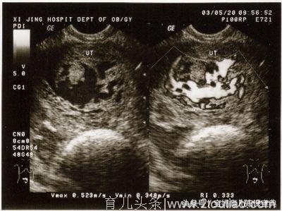 孕妇怀孕3个月肚大如临盆，医生检查后脸色变了：当即要求剖腹
