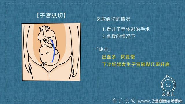 刨宫产真的可怕吗？解密刨宫产全过程