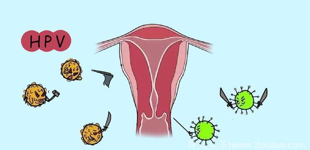 感染HPV和宫颈癌之间有多远？打了疫苗就不会得癌了吗？