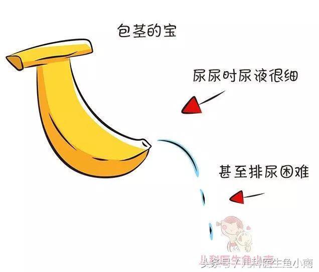 宝宝的“小香蕉”割不割？为什么要割？医生：爸妈首先要了解3点