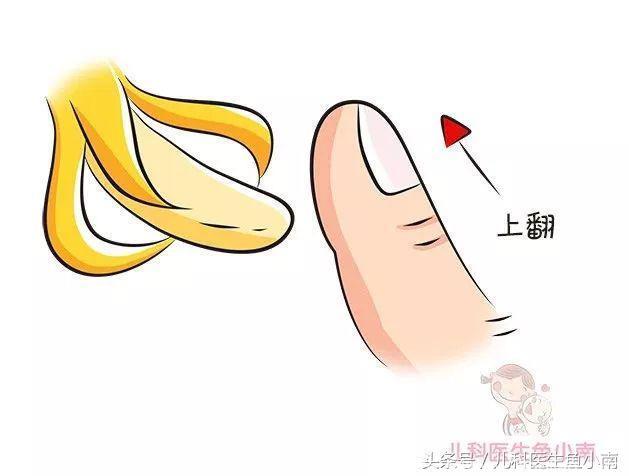哪些宝宝最需要割“小香蕉”？医生指出这些症状，请爸妈仔细对照