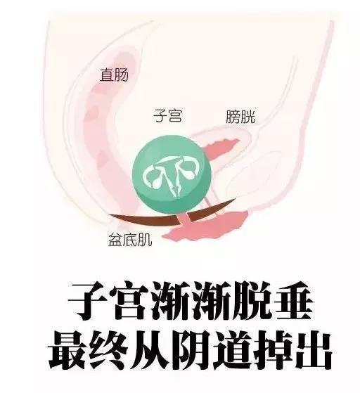 分娩之后你有在意过产后康复这个事情吗？