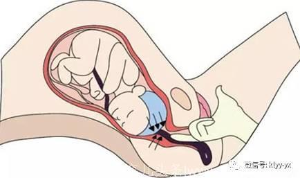 分娩｜分娩时胎儿的必经之地，决定你的分娩方式