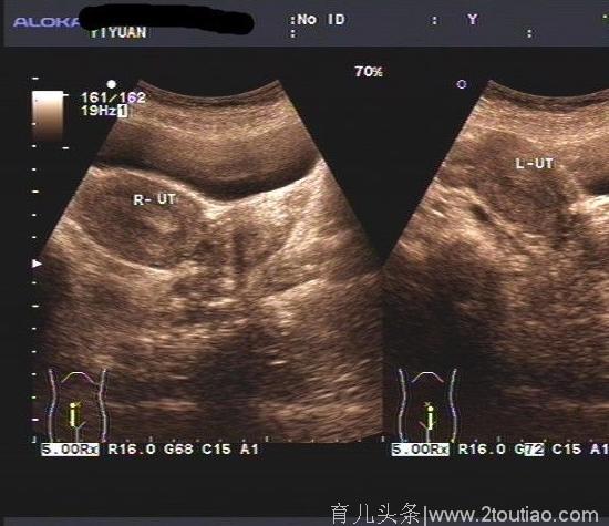 [子宫畸形] 双子宫备孕两月成功怀上了,姐妹们一定不要放弃！