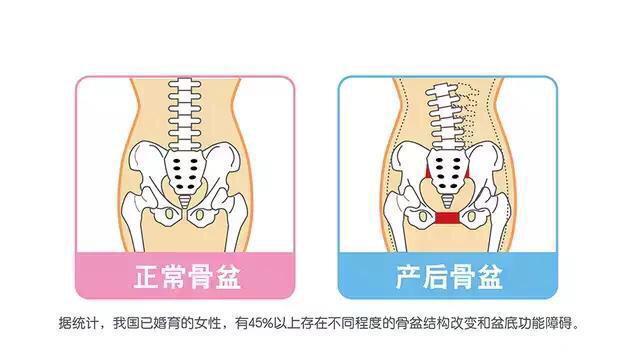 医生说：产后恢复这10件事做不好，事在伤害自己，错了就改过来！