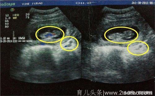 孕妇十月怀胎产下双胞胎男宝，护士报喜后，婆家反倒没一人开心