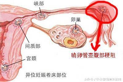 「好孕经验」曲阜面馆夫妻二胎输卵管梗阻、粘连放弃试管自然怀孕