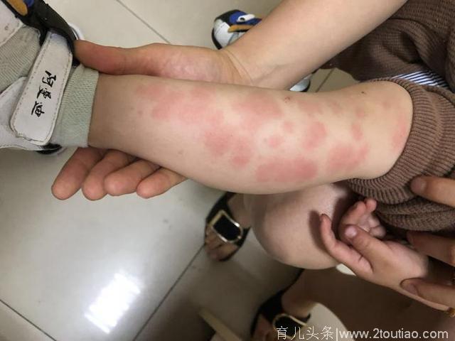 痒死宝宝了！杭州幼儿丘疹性荨麻疹高发 小心这些致敏原