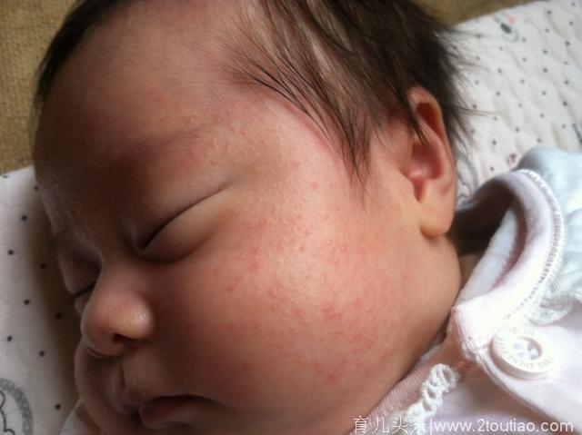 为何宝宝湿疹擦了药膏却更严重？