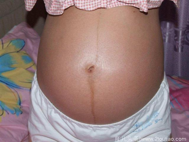 孕妇肚子上的黑线，有什么作用？产后会消失吗？