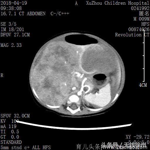 “儿童健康公益行动”：巨大肿瘤占据9月幼儿腹腔 破溃致休克