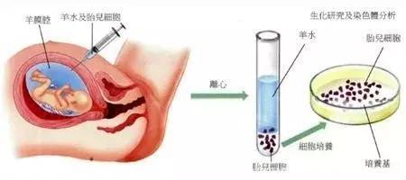 产前筛查和产前诊断