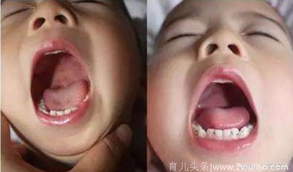 孩子出现哪些症状需怀疑疱疹性咽峡炎？