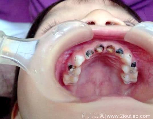 一周岁的孩子牙齿全都烂掉了，这个坏习惯，你家也可能有