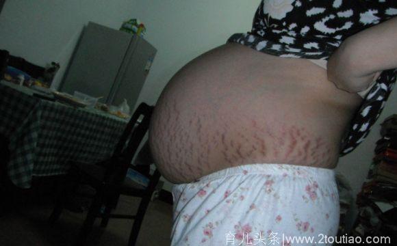 原来怀孕到这个月的时候，孕妈们就要注意防止“妊娠纹”了！