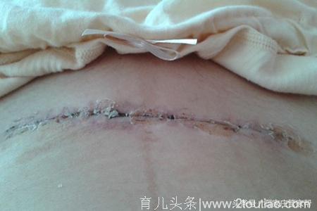 剖腹产小知识：（五）产后刀口发痒，这样来处理