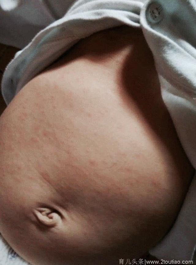 6个月大的宝宝突然发烧，原来是幼儿急疹