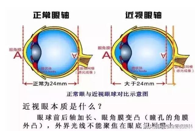 爱吃甜食、弹钢琴的孩子更容易近视？幼儿眼健康知识了解一下！