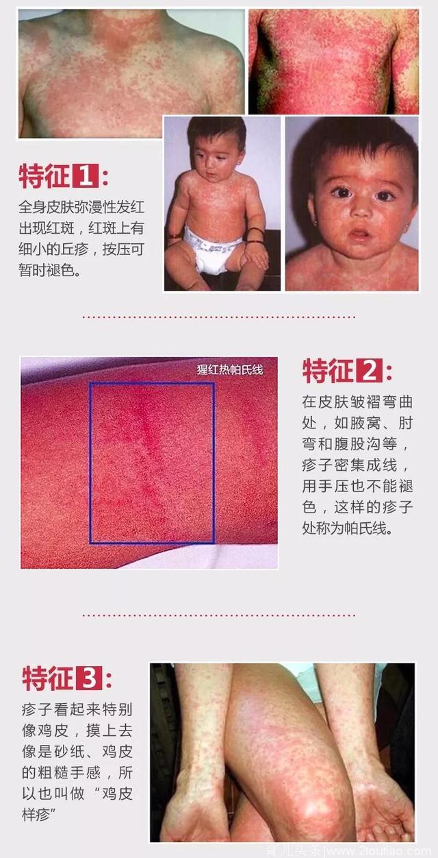 猩红热染病率已上升90.51%！一篇教你如何护理和预防