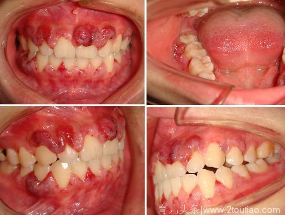 杭州一女子怀孕后牙龈上多了一块肉，一查竟是妊娠期龈瘤……