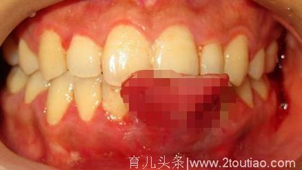 杭州一女子怀孕后牙龈上多了一块肉，一查竟是妊娠期龈瘤……