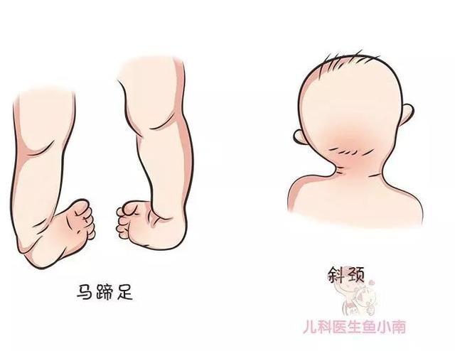 宝宝腿纹臀纹不对称就是髋关节发育不良吗？为啥说越早发现越好