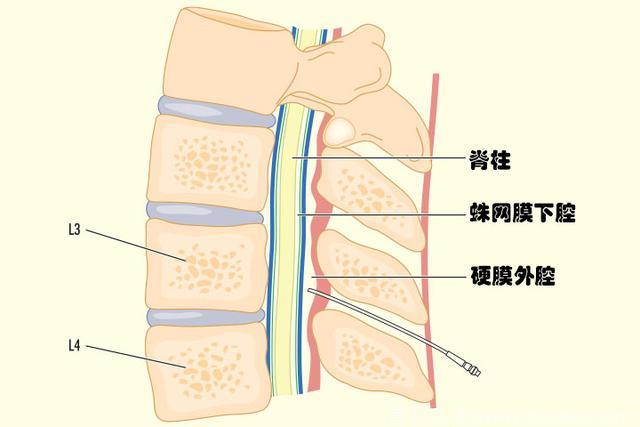 准爸妈看过来，告诉你什么是无痛分娩？