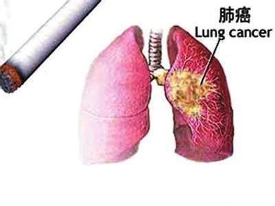很遗憾，肺癌被发现时已是中晚期！出现这6个特征，要及时检查