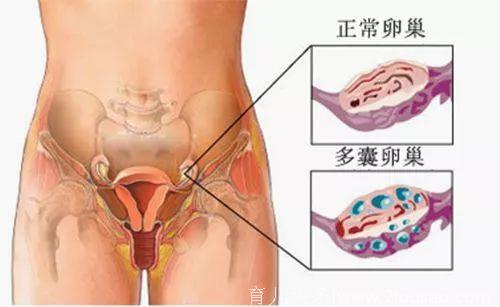 多囊卵巢综合征危害有多大？备孕妈妈们注意了！