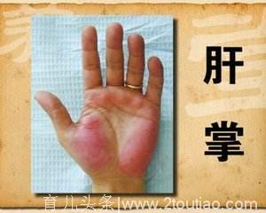 肝炎恶化，双手会发出哪些“求助”信号？是时候重视了，不能忽视