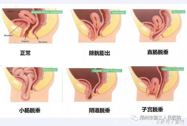 郑州市三院科普：盆底肌修复比想象中更重要，新妈妈产后不可忽视
