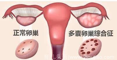 备孕路上的拦路虎——多囊卵巢综合征