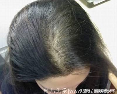 国颐堂养发馆：产后脱发好严重，我会变秃子吗？