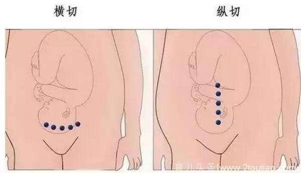 剖宫产后不管是横刀口还是竖刀口，第8点做对，产后大肚腩变平平