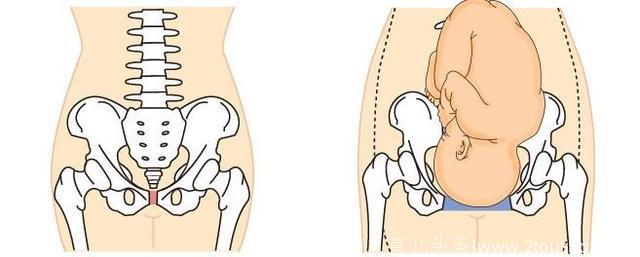 产后妈妈烦恼的身材问题，归根是骨盆问题