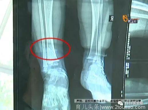 孩子左脚骨折医院却包扎了右脚 医生这样解释