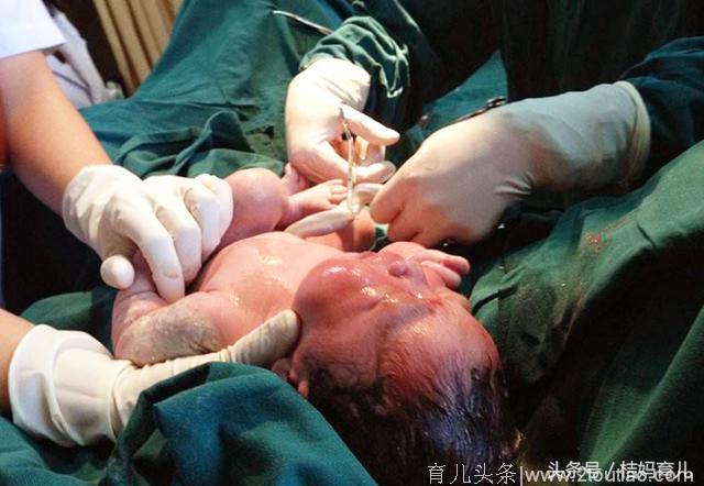 二胎剖腹产男翻女！只因26岁孕妇B超检查时遇到这种情况！