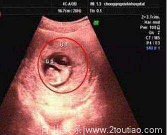 孕检没胎心，可能是胚胎停育