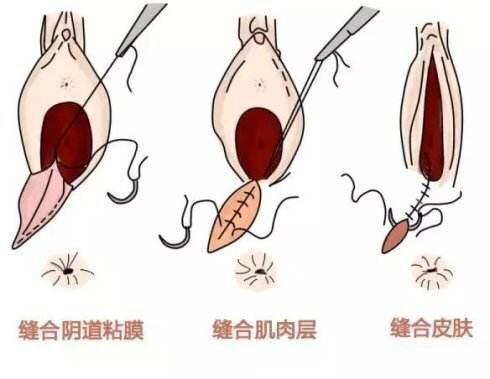 分娩时，自然撕裂和侧切，究竟有什么区别