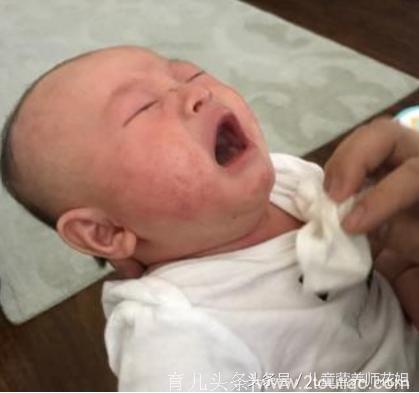 湿疹对宝宝危害不小，注意日常护理，孩子少受罪！