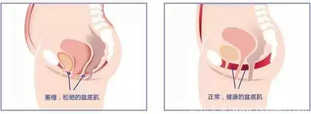 盆底肌：一胎不修复，二胎损伤更大！