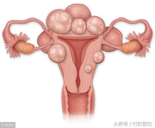 子宫肌瘤可以怀孕吗？怀孕后发现子宫肌瘤怎么办？