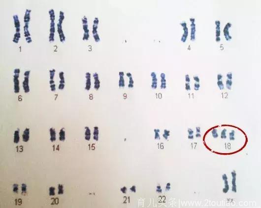 无创DNA低危却生出畸形儿！避免弱智宝宝出生，最可靠的检查是它