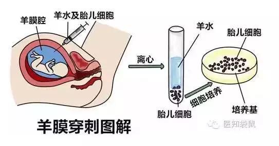 无创DNA低危却生出畸形儿！避免弱智宝宝出生，最可靠的检查是它