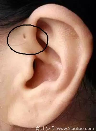 注意！你耳朵有这种小孔吗？如果有要小心了！