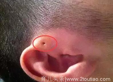 注意！你耳朵有这种小孔吗？如果有要小心了！