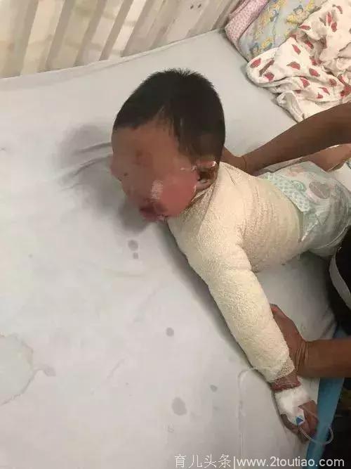男婴被100℃洗澡水烫伤！医生都点赞妈妈的急救，当时全家却反……