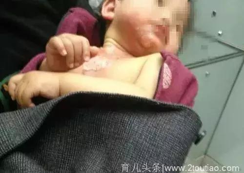 男婴被100℃洗澡水烫伤！医生都点赞妈妈的急救，当时全家却反……